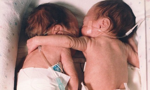 Đặt bé sơ sinh hấp hối nằm cạnh chị sinh đôi... kết quả chấn động