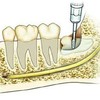 Tại sao không thể nhổ hết răng khôn cùng một lúc?