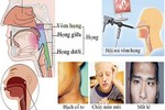 Cách điều trị ung thư vòm họng di căn