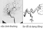 Nguy hiểm dị dạng động tĩnh mạch não bẩm sinh