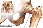 Sơ cứu khi bị tai nạn gẫy xương