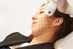 Trẻ hơn 10 tuổi nhờ công nghệ Thermage