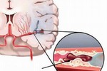 Cách điều trị thiếu máu não hiệu quả