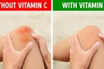 5 dấu hiệu cho thấy cơ thể đang thiếu vitamin C cần bổ sung ngay