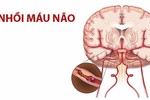 Dấu hiệu nhồi máu não nhẹ, đừng đợi mạch tắc mới khám