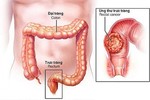 Hà Nội: Tầm soát ung thư đại trực tràng miễn phí