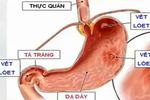 Video: Thói quen ăn uống gây ung thư dạ dày bạn cần bỏ ngay