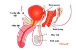 Điều trị ung thư tuyến tiền liệt: lợi bất cập hại