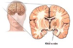 Chủng vi rút sởi có thể tiêu diệt u não trẻ em