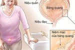 12 bài thuốc hỗ trợ điều trị viêm bàng quang cực hiệu quả