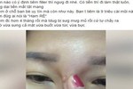 Hotgirl bị chảy dịch mủ sau tiêm filler nâng mũi 