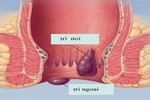 Với bài thuốc này, trĩ nội, trị ngoại đều khỏi hết