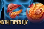 Cách phát hiện sớm ung thư tụy sâu trong ổ bụng