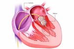 Cứu sống bé 9 ngày tuổi tím tái vì dị tật tim bẩm sinh