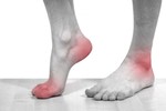 Dấu hiệu chứng tỏ bạn đã mắc bệnh gout