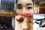 Spa Chu Huyền nói gì khi làm mù mắt cô gái tiêm filler nâng mũi?