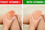 Những dấu hiệu cảnh báo cơ thể đang thiếu hụt vitamin C