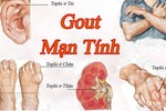 Kinh hoàng hình ảnh bệnh gout tàn phá cơ thể