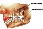 “Răng khôn mọc dại” và những biến chứng chết người 