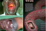 90% trường hợp mắc sốt xuất huyết Ebola sẽ tử vong