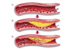 Xơ vữa động mạch liên quan gì thiếu máu não?