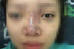 Nữ sinh bị mù mắt khi tiêm filler: Dấu hiệu đáng ngờ bên trong spa