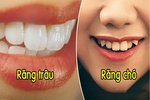 Xem tướng răng biết ngay vận mệnh sang - hèn, sướng - khổ