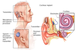 Cấy ốc tai điện tử và loạt biến chứng nguy hiểm