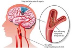 Nắng nóng 41 độ, hãy chú ý đến 7 dấu hiệu sớm của đột quỵ này để giúp bạn thoát chết 