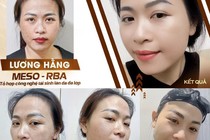 Công nghệ làm đẹp Meso-RBA đang hot tại thị trường thẩm mỹ Việt