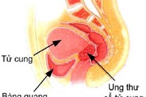 Các cách chăm sóc bệnh nhân ung thư cổ tử cung