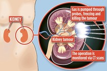 Chữa ung thư thận bằng cách đóng băng khối u