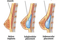 Phẫu thuật nâng ngực