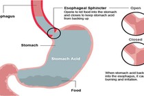 Cách giảm tức thời chứng trào ngược thực quản