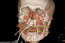 Khuôn mặt được vá 13 miếng kim loại và 52 đinh vít