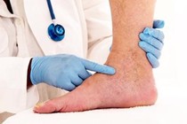 Chế độ dinh dưỡng cho người bệnh huyết khối tĩnh mạch sâu