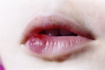 6 nguyên nhân môi bị mưng mủ sau phun xăm và cách xử lý