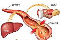 Tại sao rối loạn lipid máu nguy hiểm? 