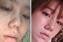 Vụ khách hàng tố Klain Beauty làm hỏng mũi: Công ty Klain dính phạt nhiều vi phạm