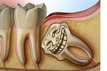 Video: Sự tích răng khôn và vì sao chúng hành hạ con người đến vậy?