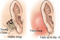 Tai có mùi hôi thối - triệu chứng của nhiều bệnh lý nguy hiểm