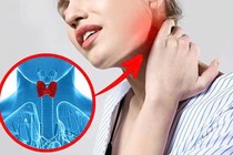 Bệnh tuyến giáp ngày càng tăng, phòng ngừa thế nào?