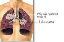 Cần điều trị sớm ung thư phổi