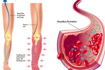 Có dấu hiệu này chứng tỏ cơ thể đang có cục máu đông 