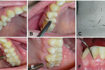 Cô gái 25 tuổi mọc lông ở nướu răng, bác sĩ sửng sốt