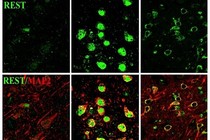 Bảo vệ não ngừa bệnh Alzheimer