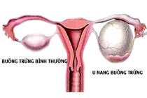 Sự thật mọi phụ nữ cần biết về u nang buồng trứng