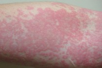 Ớn lạnh xem hình ảnh bệnh lupus ban đỏ chết người