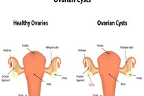 U nang buồng trứng tự triệt tiêu với mẹo dễ thực hiện