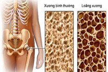 Đối phó với chứng đau nhức xương khớp ở người cao tuổi 